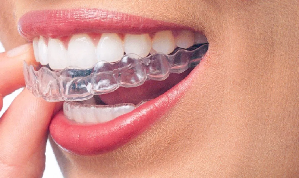 Invisalign Provider in Decatur, GA
