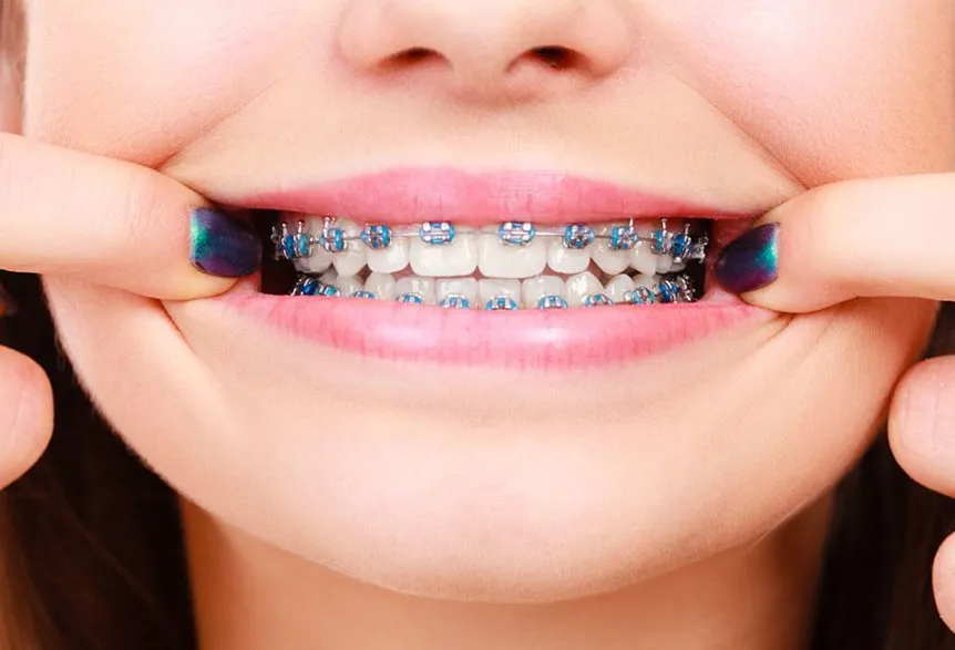 Cost of Braces for Children in Decatur, GA