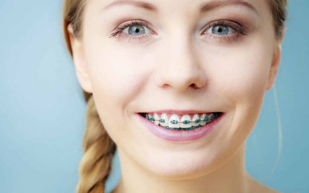 Young woman showing teeth braces