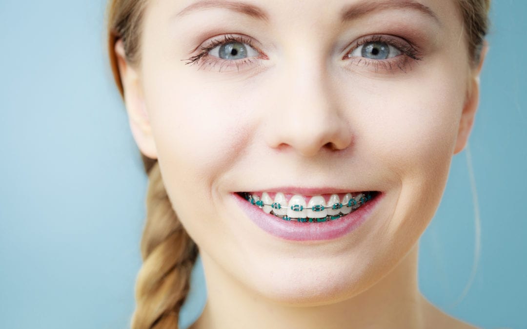 Cost of Braces for Adults in Atlanta, GA